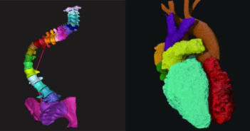 How digital manufacturing enables growth in patient-specific design Medical Image Segmentation