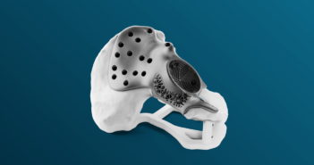 3D printed medical implant