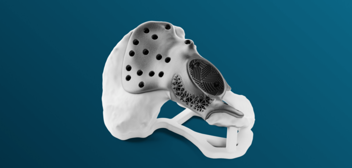 3D printed medical implant