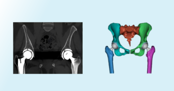 From scan to surgery: Understanding workflow for patient-specific implant design