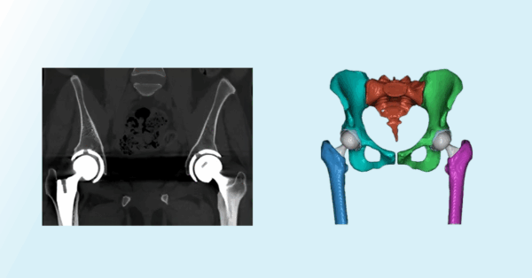 From scan to surgery: Understanding workflow for patient-specific implant design 
