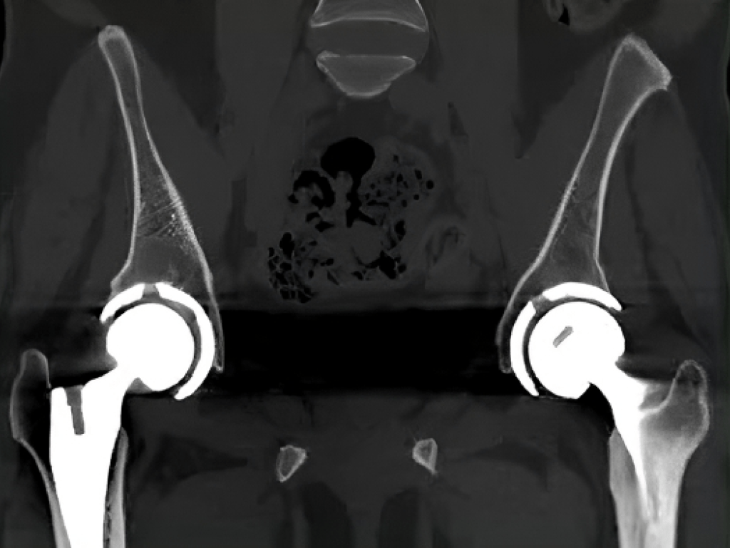 Hips